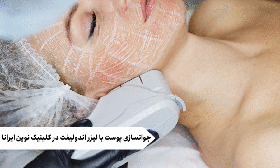 جوانسازی پوست با لیزر اندولیفت در کلینیک نوین ایرانا