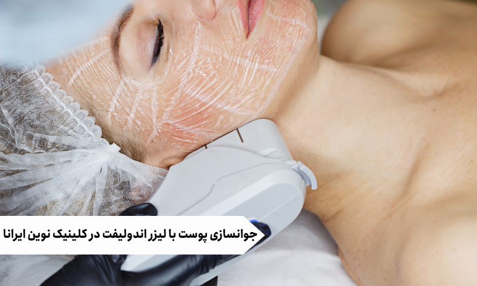 جوانسازی پوست با لیزر اندولیفت در کلینیک نوین ایرانا